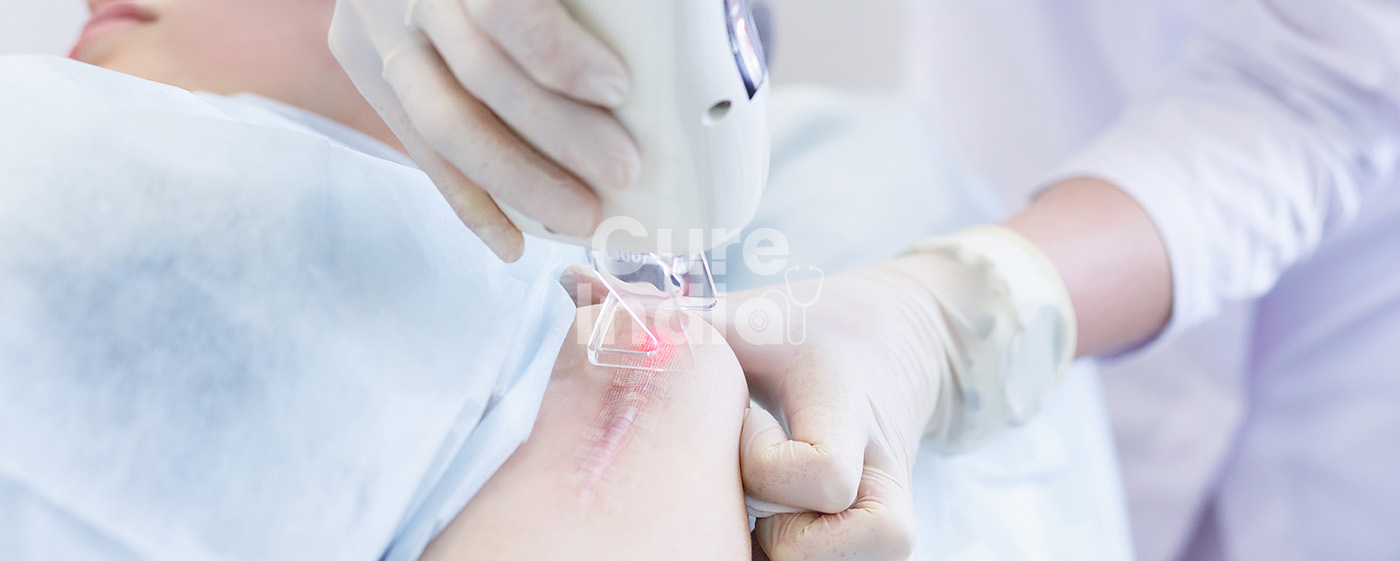Scar Removal Surgery